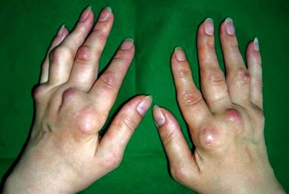 The hand is affected by polyosteoarthritis deformans