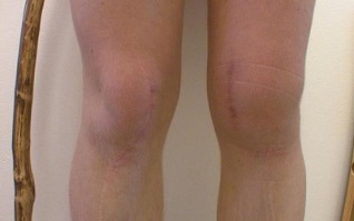 stage of development of knee arthrosis