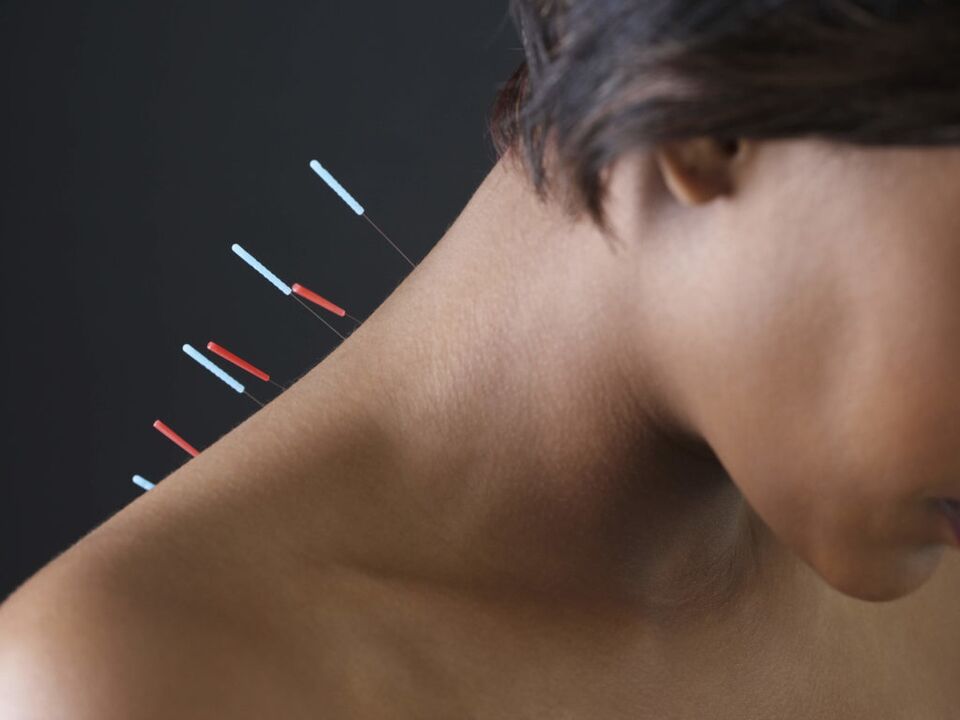 Acupuncture for cervical osteochondrosis eliminates the inflammatory process