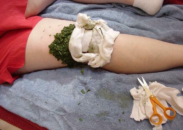 Warm compresses of crushed cabbage leaves on knee joints that are painful with arthrosis